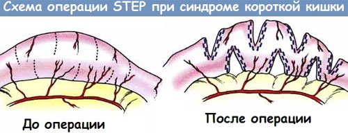 Операция при синдроме короткой кишки