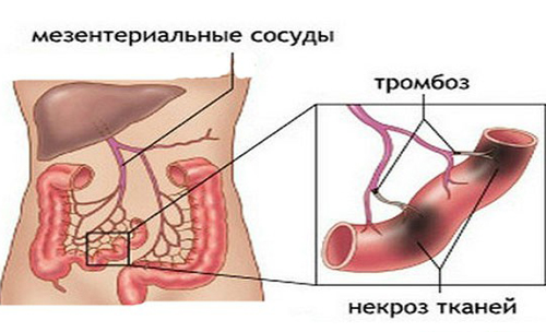 Тромбоз