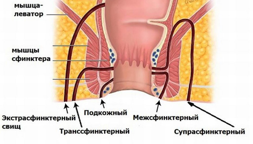 Виды свищей