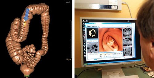 Виртуальная колоноскопия