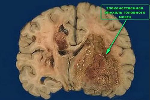 Очаговые симптомы