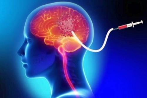 Глиобластома - классификация