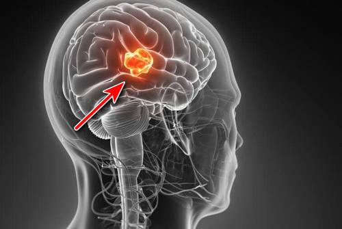 Глиобластома - причины