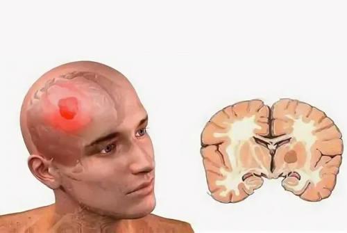 Глиобластома - симптомы