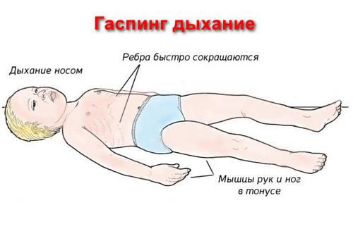 гаспинг дыхание