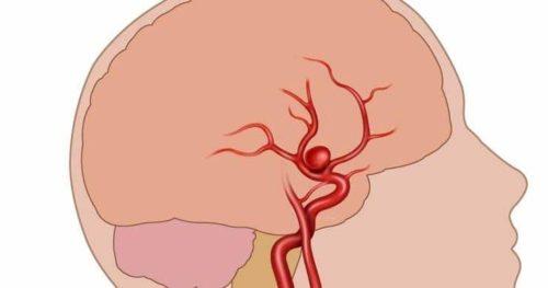 Аневризма сосудов