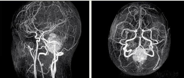 Ангиография сосудов головного мозга