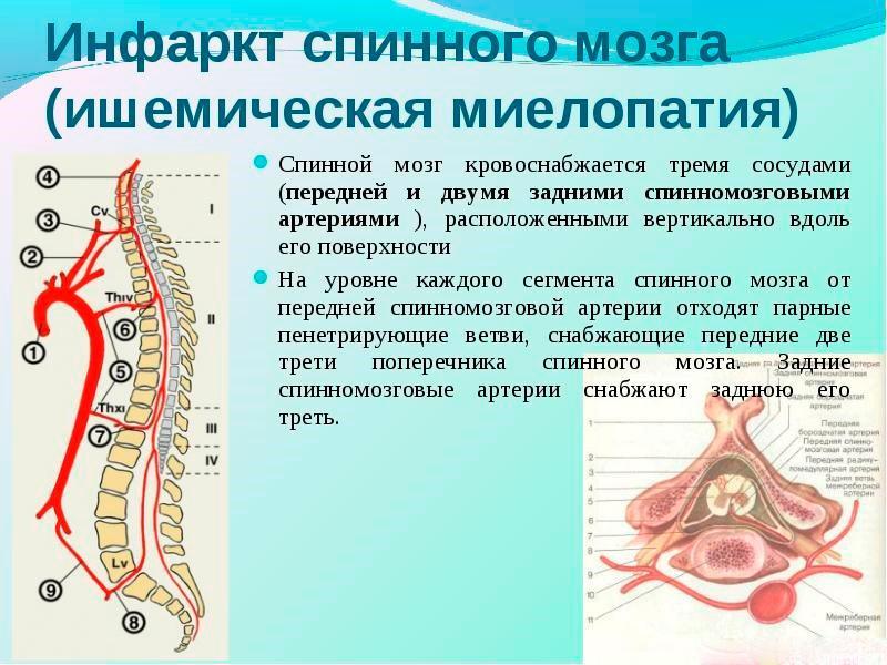 Ишемическая миелопатия