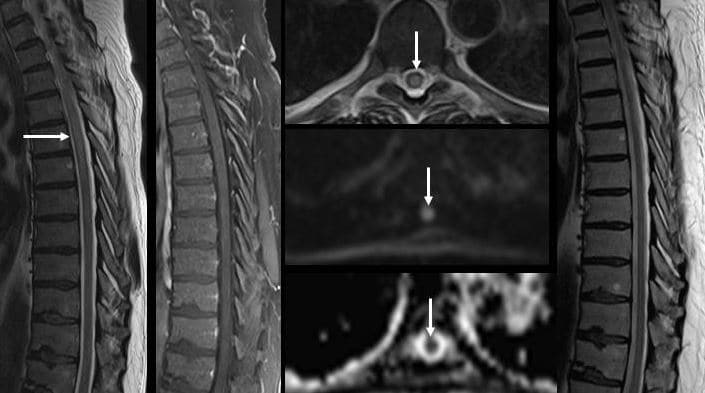 МРТ поперечного миелита