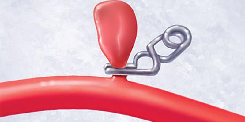 Операция при аневризме головного мозга