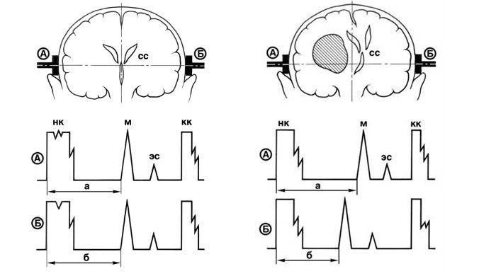 Расшифровка эхоэнцефалограммы