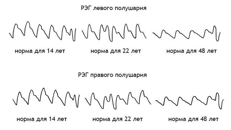 Расшифровка РЭГ