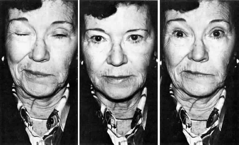 Виды нервного тика