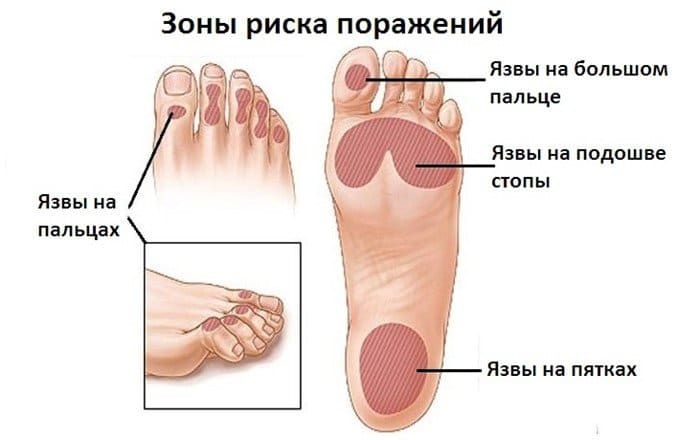 Зоны риска поражений